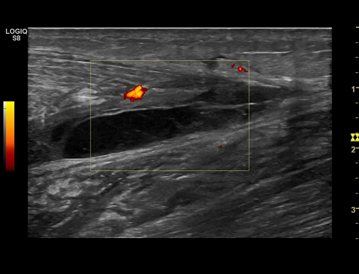 Ultrasound image: Ruptured calf muscle – image depicts a hematoma (blood clot and swelling within the tissues)