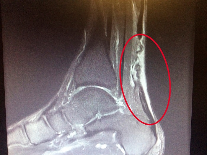 MRI (side view) of an injured Achilles tendon.