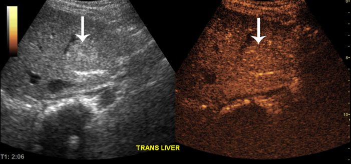 Stark contrast: a new tool to image the liver