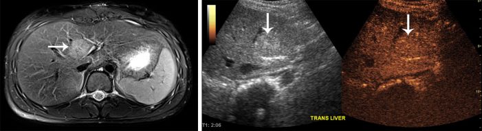 tark contrast: a new tool to image the liver